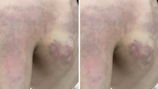 Phụ huynh tố giáo viên đánh bầm tím vai học sinh lớp 3