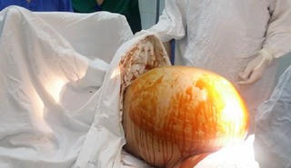 Sinh ra khối u 7 kg sau 9 tháng “mang bầu“