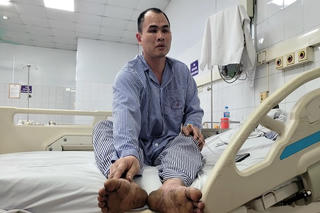 Nạn nhân thoát chết kể lại sự cố cháy nổ khí metan