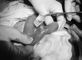 F0 thủng ruột vì uống cả vỏ thuốc vào bụng