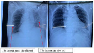 Cứu sống ca COVID-19 tiền sử tăng huyết áp kèm đột quỵ 