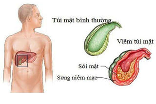 4 dấu hiệu cảnh báo bệnh lý sỏi mật