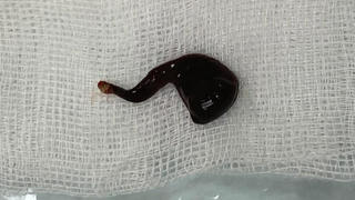 Đỉa 5cm 'làm tổ' trong mũi nam thanh niên gần cả tháng