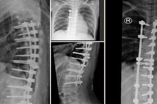 Bé gái 11 tuổi bị chứng lưng cong nguy hiểm