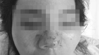 Hỏng cả mặt, mũi vì tiêm thử filler