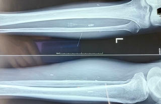 Người cựu chiến binh sống chung với mảnh pháo suốt 49 năm