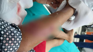 Bé trai 8 tuổi bị chó cắn tổn thương nhiều vùng trên cơ thể