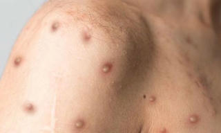 Việt Nam khống chế được ca bệnh đậu mùa khỉ đầu tiên