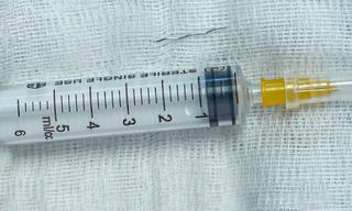 Sợi thép rây lọc cháo đâm xuyên amidan trẻ 13 tháng tuổi