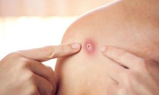 1 nam thanh niên mắc đậu mùa khỉ tử vong