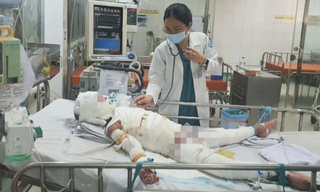 Mẹ chấp nhận lóc toàn bộ da đùi cứu con bị bỏng cồn