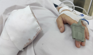 Phẫu thuật chuyển ngón chân thành ngón tay cho người phụ nữ bị nát bàn tay