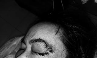 Thêm 1 phụ nữ bị chó cắn phải nhập viện