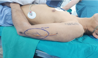 Tạo hình lưỡi bằng vạt cánh tay cho người bệnh ung thư