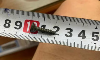 Trẻ 3 tuổi nuốt nhầm đinh ốc vít