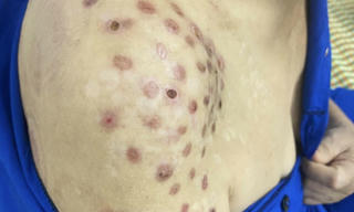 Lở loét vì đốt hương trị đau nhức vai gáy