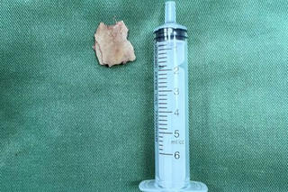 Nhập viện sau hơn 1 năm hóc xương lợn