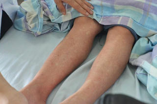 Bác sĩ cảnh báo biến chứng nguy hiểm của sốt xuất huyết