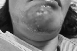 Người phụ nữ nhập viện do dán cao trị mụn