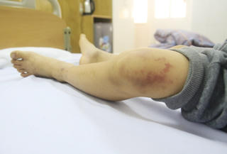 Bé trai mới 8 tuổi đã đau khớp, đi lại khó khăn vì bệnh này