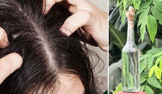 Nhập viện vì dùng rượu ngâm hạt na diệt chấy