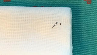 Nguy hiểm khôn lường khi mũi kim khâu đâm vào người