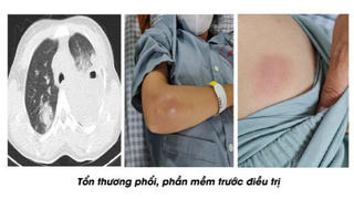 Nữ bệnh nhân nhiễm vi khuẩn Whitmore áp xe nặng, suy kiệt