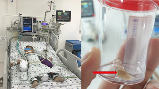 Bé trai nguy kịch vì mảnh xương trong nước hầm nấu cháo găm vào phế quản