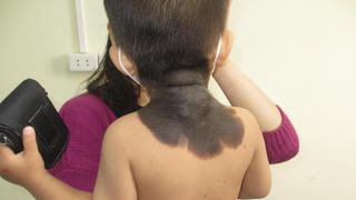 Bé trai bị bớt đen, đi khám phát hiện bệnh hiếm gặp