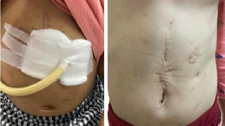 Bỏng thực quản vì bất cẩn của cha mẹ 