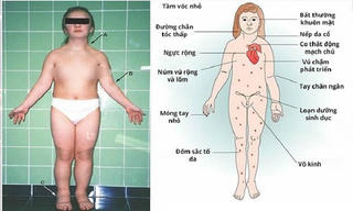 Bé gái mãi không lớn, cảnh giác với Hội chứng Turner