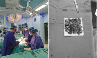 Biến dạng 'cậu nhỏ' vì tự bơm silicon tăng kích thước 