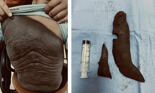 Hai bé trai phải phẫu thuật gấp để loại bỏ "bớt đen khổng lồ"