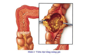 Mối nguy hại từ việc điều trị kháng sinh dài ngày 