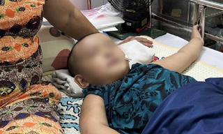 2 bệnh nhi mắc chứng động kinh co giật nửa người 