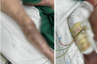 Người phụ nữ nguy kịch vì con cá trê 