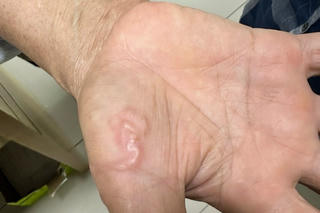 Ngứa sẩn khắp người vì nuôi chó mèo