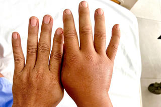 Cảnh báo gia tăng số người bị rết cắn sau mưa bão
