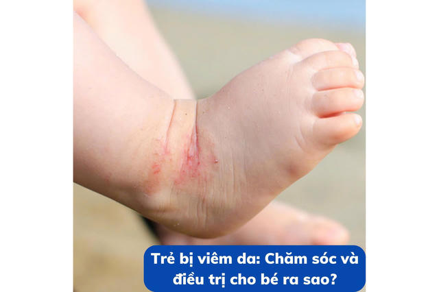 Trẻ bị viêm da: Chăm sóc và điều trị cho bé ra sao?