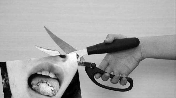 Phần lưỡi của chị Nở được nối nhưng cuối cùng phải vứt bỏ (Ảnh gia đình cung cấp).