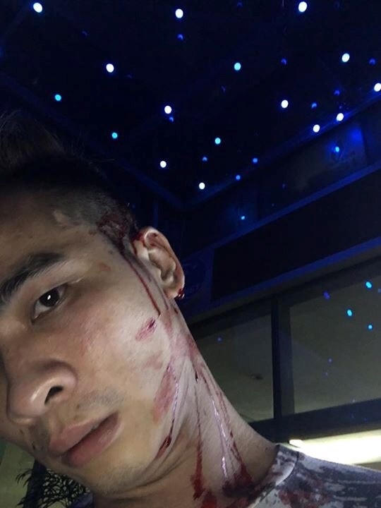 Anh Nguyễn Kiên (SN 1985) bị đánh tại Q Club.