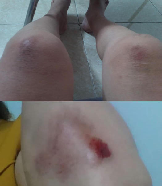 Chị Phương bị thương sau can ngăn xô xát giữa nam thanh niên đi xe SH và người em.