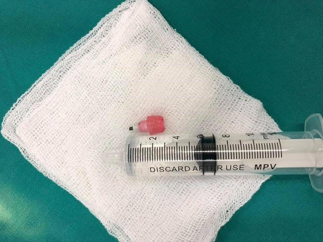 Dị vật đầu bút chì dài 2cm được gắp ra từ phế quản của bệnh nhi 6 tuổi. Ảnh: BVCC