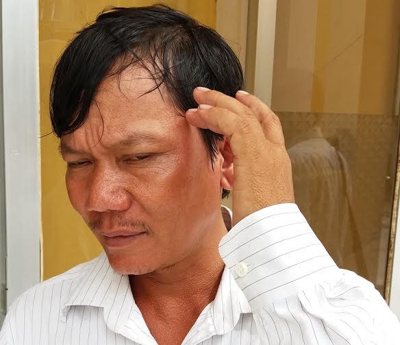 Ông Lảnh chỉ vào vùng thái dương lúc bị đánh.