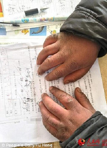 Bàn tay nứt nẻ vì lạnh của cậu bé Trung Quốc. Ảnh: Nhân dân Nhật báo.