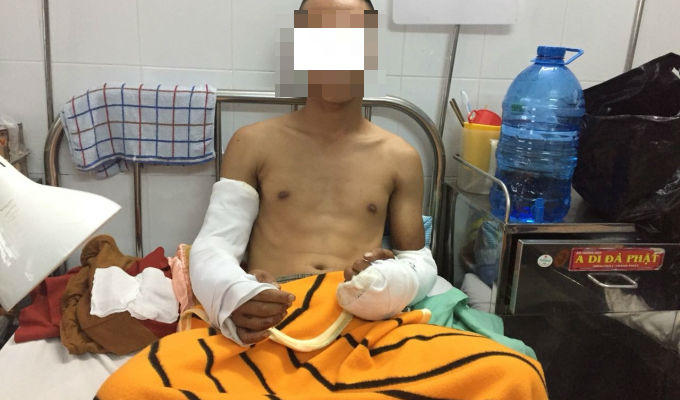Nạn nhân Bùi V. T. bị chém đứt gân cả hai cánh tay.