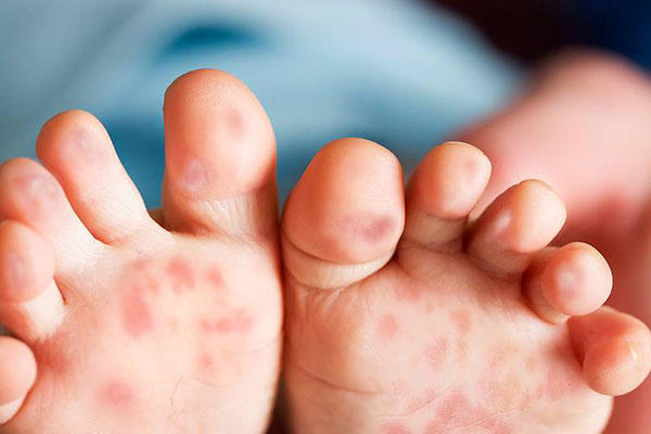 Dịch tay chân miệng đang có xu hướng gia tăng. Ảnh: minh họa