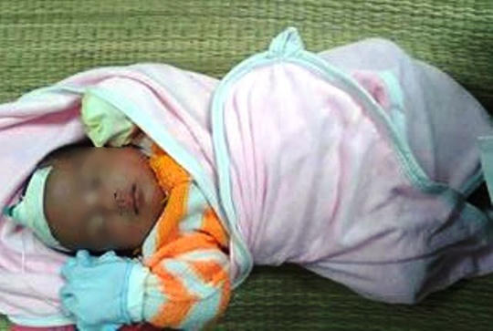 Bé T. nhập viện trong tình trạng ngừng hô hấp, tuần hoàn, mặt tím tái.