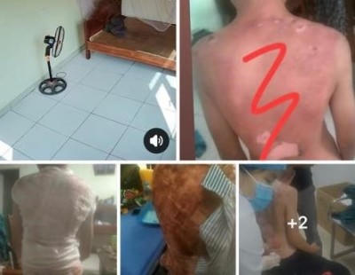 Những vết thương trên người cháu bé bị bỏng được người thân chia sẻ