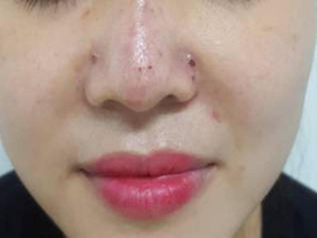 Người phụ nữ bị biến chứng bầm tím, đau tức sau tiêm filler. Ảnh: plo.vn